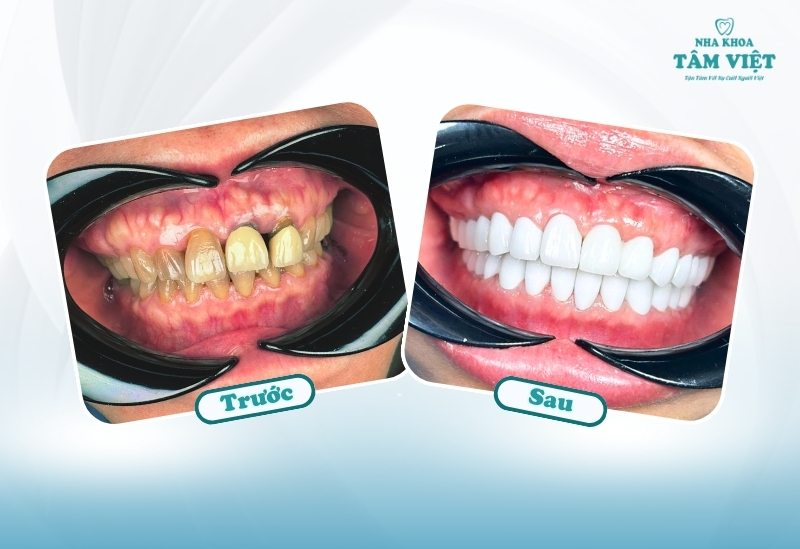 Bọc răng sứ chữa vẩu: Giải pháp cho nụ cười đẹp 2 Bọc răng sứ có thực sự chữa được vẩu không?