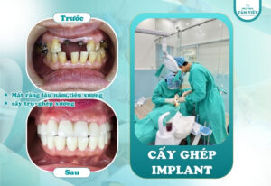 Cắm trụ implant bao lâu thì gắn răng? Lưu ý quan trọng