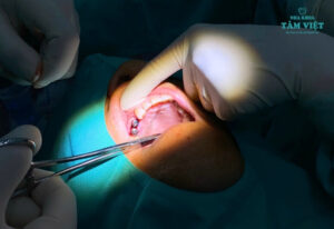 Bí quyết chăm sóc răng sau cấy ghép Implant hiệu quả