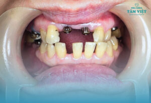 Cập nhật chi phí trồng 1 răng implant tại nha khoa uy tín