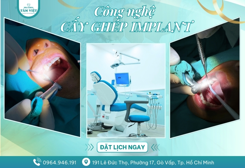 Công nghệ cấy ghép Implant hiện đại có gì đặc biệt?