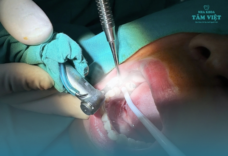 Công nghệ cấy ghép Implant hiện đại có gì đặc biệt? 2 Công nghệ cấy ghép Implant là gì?