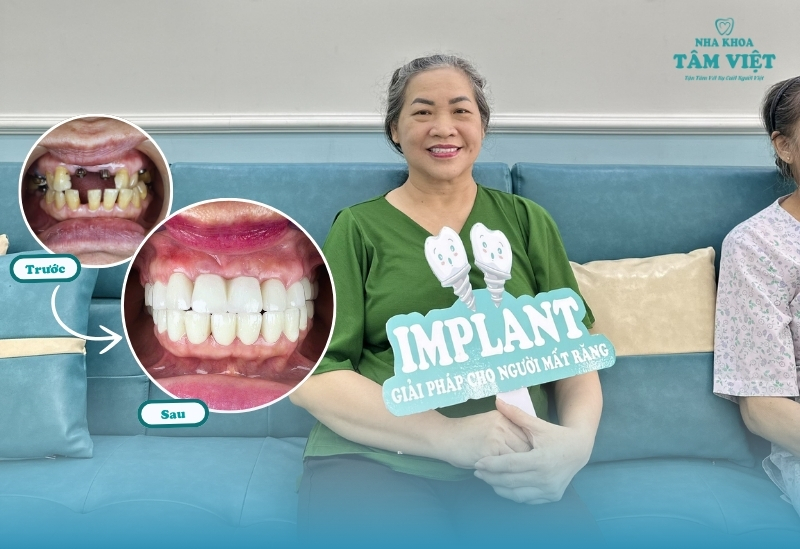 Công nghệ cấy ghép Implant hiện đại có gì đặc biệt? 4 Lợi ích của công nghệ cấy ghép Implant hiện đại