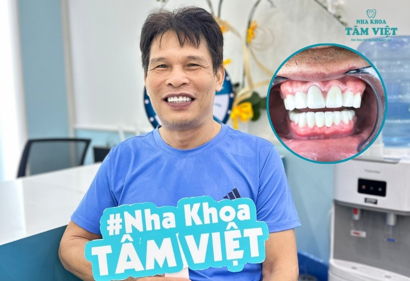 Tìm địa chỉ làm răng sứ giá rẻ, bền đẹp ở đâu? 2 Giá răng sứ hiện nay là bao nhiêu?