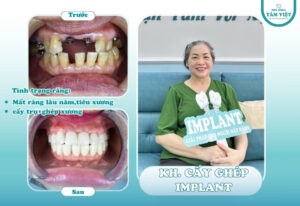Địa chỉ trồng răng implant uy tín nào nên chọn tại TPHCM?