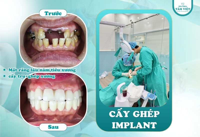 Lấy dấu implant quan trọng thế nào trong cấy ghép răng? 3 Lấy dấu implant quan trọng thế nào trong cấy ghép răng?
