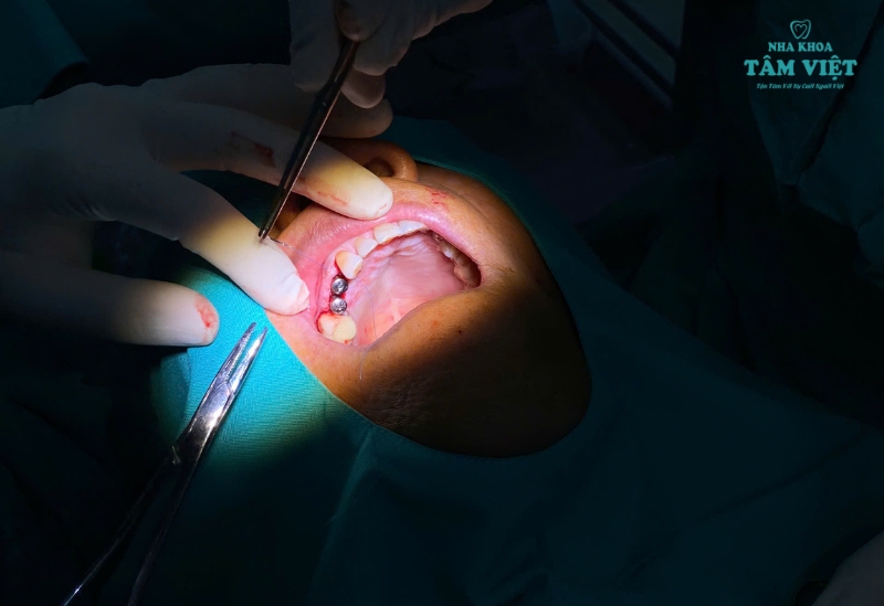 Chi tiết quy trình cắm răng implant từ A-Z bạn cần biết 2 Sự vượt trội của phương pháp cắm răng implant