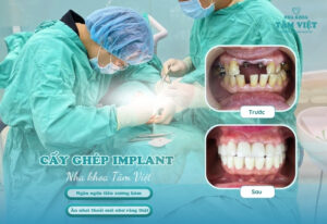 Trồng implant có niềng được không? Có ảnh hưởng gì không?
