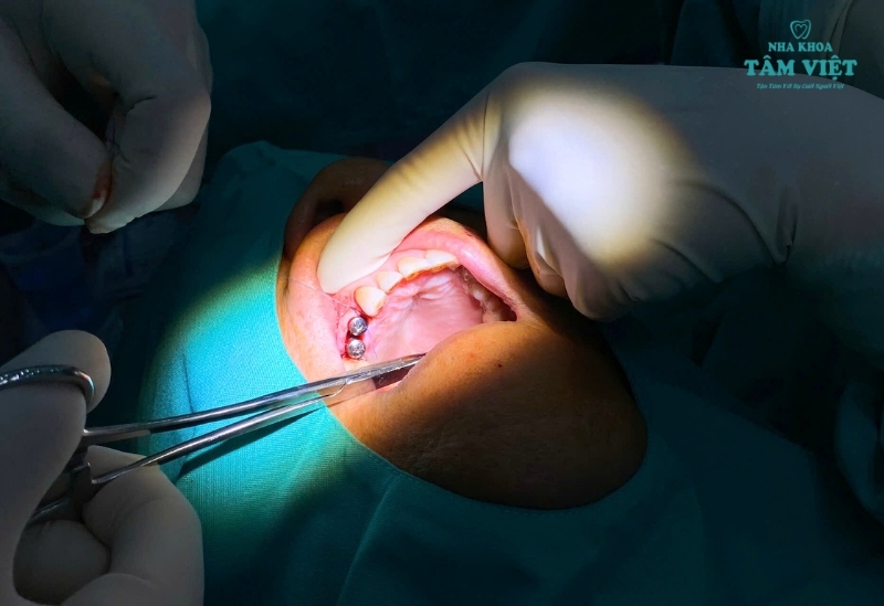 Trồng răng Implant có an toàn không?