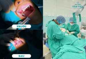 Trồng răng implant có đau không? Giải đáp chi tiết