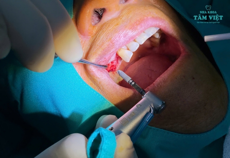 Trồng răng implant giá rẻ có tốt không? Chuyên gia giải đáp 2 Trồng răng implant giá rẻ có tốt không?