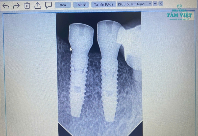 Trồng răng implant giá rẻ có tốt không? Chuyên gia giải đáp 3 Những rủi ro khi trồng răng implant giá rẻ