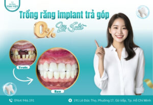 Trồng răng Implant trả góp 0% lãi suất – Đẹp mà không lo lãi
