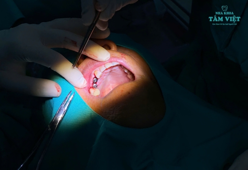 Trụ Implant Hiossen có tốt không? Đánh giá chi tiết 3 Có nên lựa chọn trụ Implant Hiossen không?