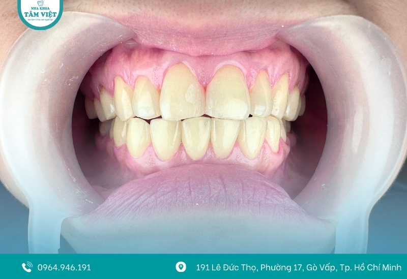 7 lưu ý khi chăm sóc răng sứ veneer để giữ bền đẹp 2 Tại sao cần chăm sóc răng sứ veneer đúng cách?