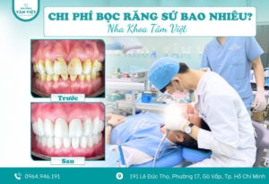 Chi phí bọc răng sứ bao nhiêu? Bảng giá mới nhất 2025