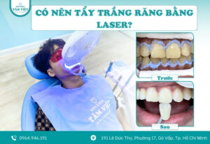 Có nên tẩy trắng răng bằng laser? So sánh hiệu quả