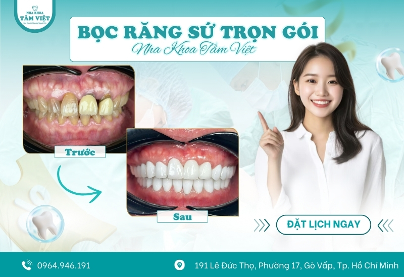 Cập nhật bảng giá bọc răng sứ trọn gói mới nhất tại nha khoa