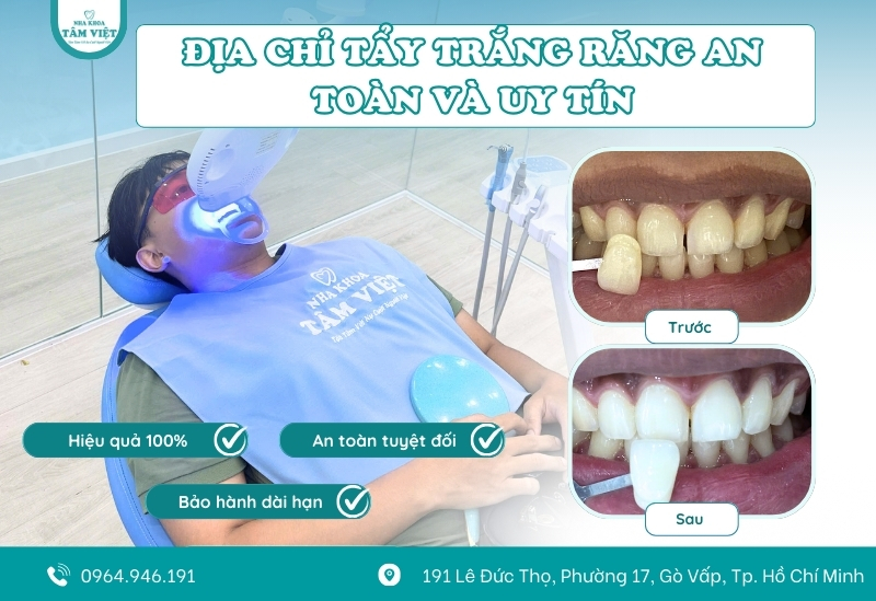 Răng xỉn màu? Tẩy trắng răng an toàn ở đâu là tốt nhất? 4 Nha Khoa Tâm Việt – Địa chỉ tẩy trắng răng an toàn và uy tín