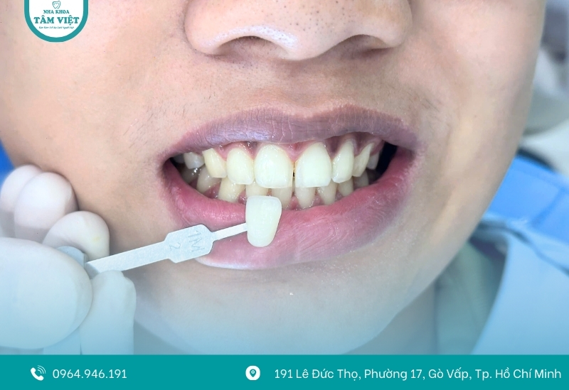 Tẩy trắng răng giá rẻ Gò Vấp ở đâu an toàn, hiệu quả? 5 Cách duy trì hiệu quả tẩy trắng răng