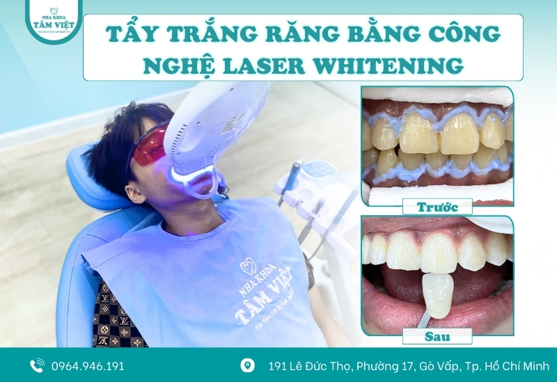 Bầu có tẩy trắng răng được không? Cần lưu ý gì? 4 Nha Khoa Tâm Việt – Địa chỉ tẩy trắng răng an toàn tại Gò Vấp
