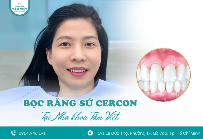 Bọc răng sứ ở đâu đẹp với 5 tiêu chí bạn cần biết