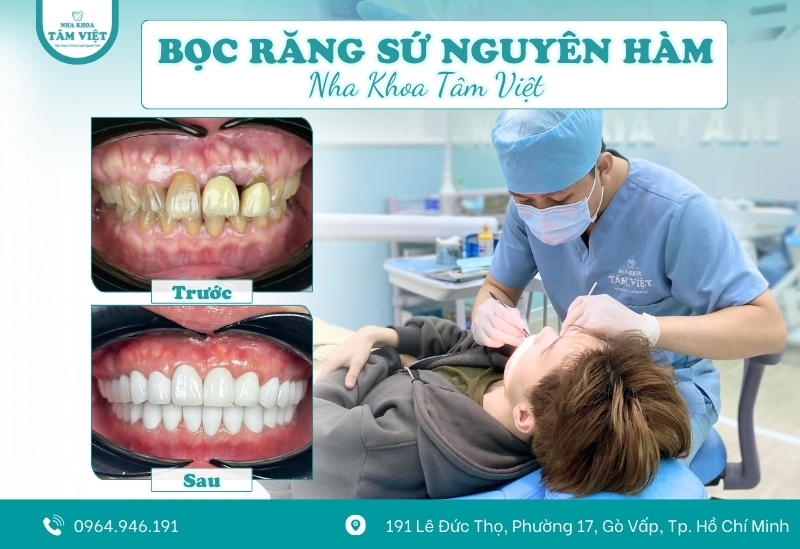 Bọc răng sứ ở đâu đẹp với 5 tiêu chí bạn cần biết 4 Nha Khoa Tâm Việt - Địa chỉ làm răng sứ uy tín không thể bỏ qua