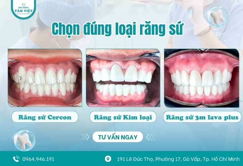 Bọc răng sứ ở đâu đẹp với 5 tiêu chí bạn cần biết 5 Nên bọc loại răng sứ nào?