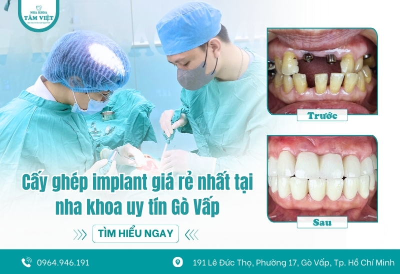 Cấy ghép implant giá rẻ nhất tại nha khoa uy tín Gò Vấp