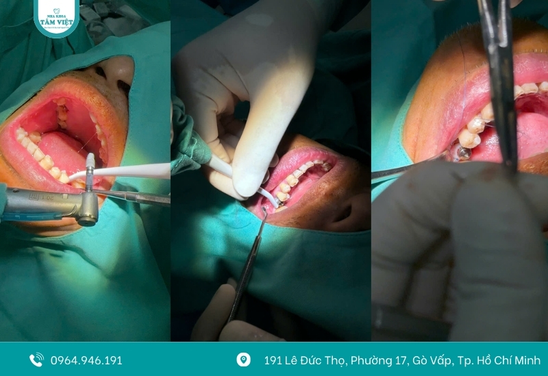 Cấy ghép implant giá rẻ nhất tại nha khoa uy tín Gò Vấp 5 Quy trình cắm implant tại nha khoa