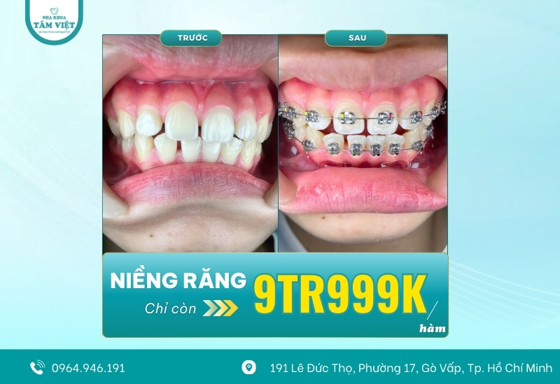 Đâu là địa chỉ niềng răng đẹp và an toàn tại TPHCM? 5 Ưu đãi niềng răng chỉ 9tr999K/1 hàm trong tháng 5