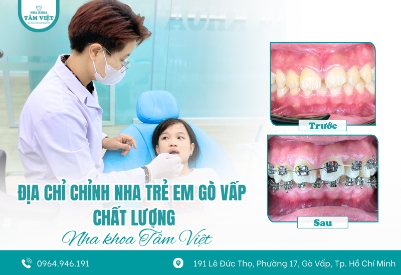 Địa chỉ chỉnh nha trẻ em Gò Vấp chất lượng