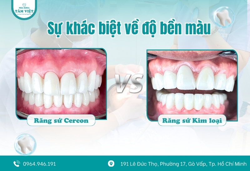 Tìm nha khoa bọc răng sứ đẹp, an toàn, chất lượng tại Gò Vấp 2 Chất lượng bền vững đến từ vật liệu sứ