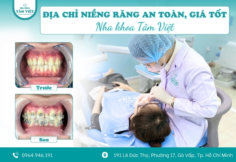 Niềng 2 răng cửa cho bé được không? Giá bao nhiêu? 4 Nha khoa Tâm Việt - Địa chỉ niềng răng an toàn, giá tốt