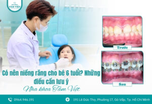 Có nên niềng răng cho bé 6 tuổi? Những điều cần lưu ý