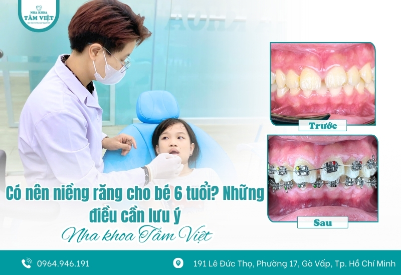 Có nên niềng răng cho bé 6 tuổi? Những điều cần lưu ý