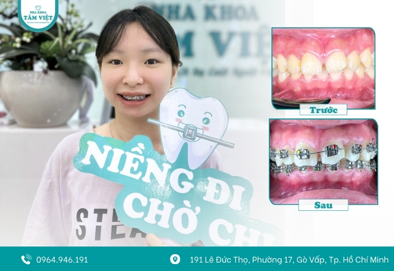 Có nên niềng răng cho bé 6 tuổi? Những điều cần lưu ý 3 Phương pháp niềng răng cho bé