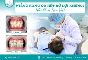 Niềng răng có hết hở lợi không? Có nên làm sớm không?