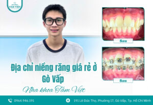 Địa chỉ niềng răng giá rẻ ở Gò Vấp bạn nên biết