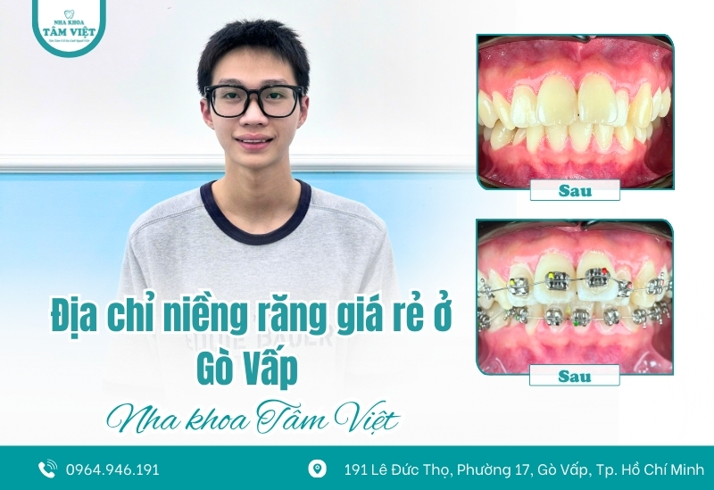 Địa chỉ niềng răng giá rẻ ở Gò Vấp bạn nên biết