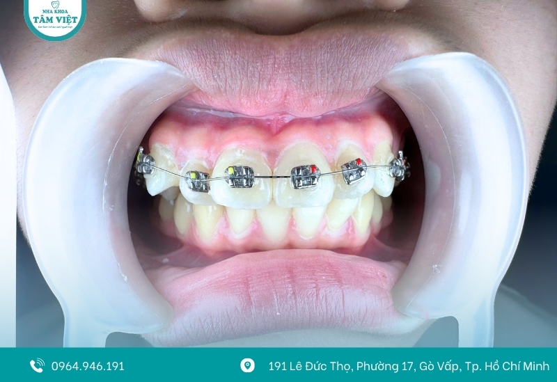 Địa chỉ niềng răng giá rẻ ở Gò Vấp bạn nên biết 3 Tình trạng răng miệng