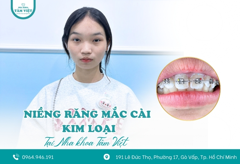 Địa chỉ niềng răng giá rẻ ở Gò Vấp bạn nên biết 4 Niềng răng mắc cài kim loại