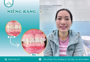 Giá niềng răng mắc cài tự buộc có đắt không? Ở đâu rẻ?