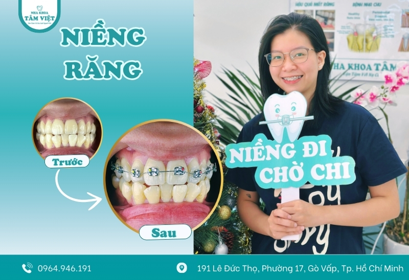 Giá niềng răng mắc cài tự buộc có đắt không? Ở đâu rẻ? 3 Giá niềng răng mắc cài tự buộc có đắt không?