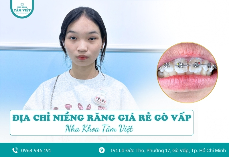 Niềng răng móm giá rẻ có thật sự an toàn như quảng cáo?