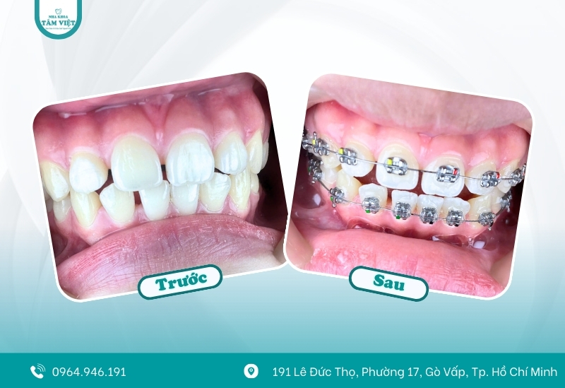 Niềng răng móm giá rẻ có thật sự an toàn như quảng cáo? 2 Tại sao niềng răng móm đòi hỏi sự chuyên nghiệp?