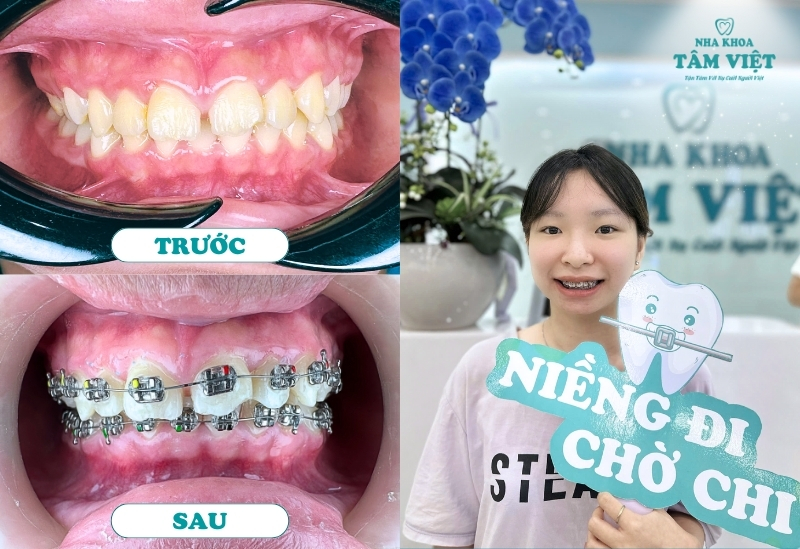 Niềng răng móm giá rẻ có thật sự an toàn như quảng cáo? 3 Có nên niềng răng cho trẻ em không?