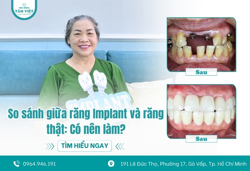 So sánh giữa răng Implant và răng thật: Có nên làm?