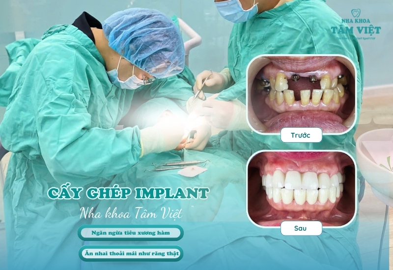 So sánh giữa răng Implant và răng thật: Có nên làm? 5 Địa chỉ trồng Implant tại Gò Vấp uy tín