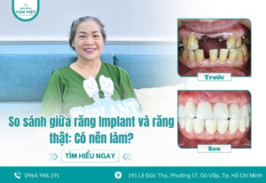 So sánh giữa răng Implant và răng thật: Có nên làm?